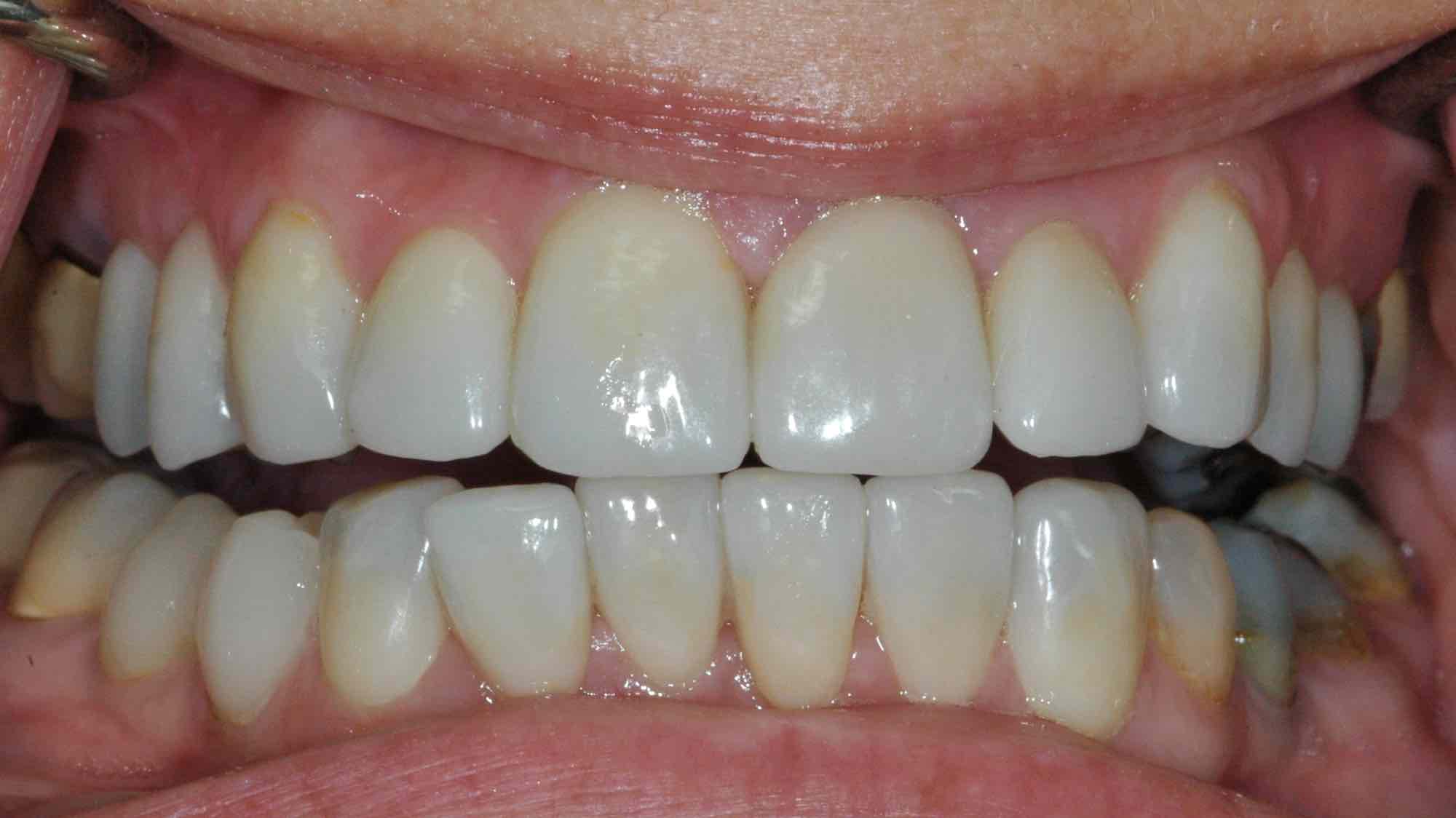Veneer-Versorgung um Form und Farbe zu verändern