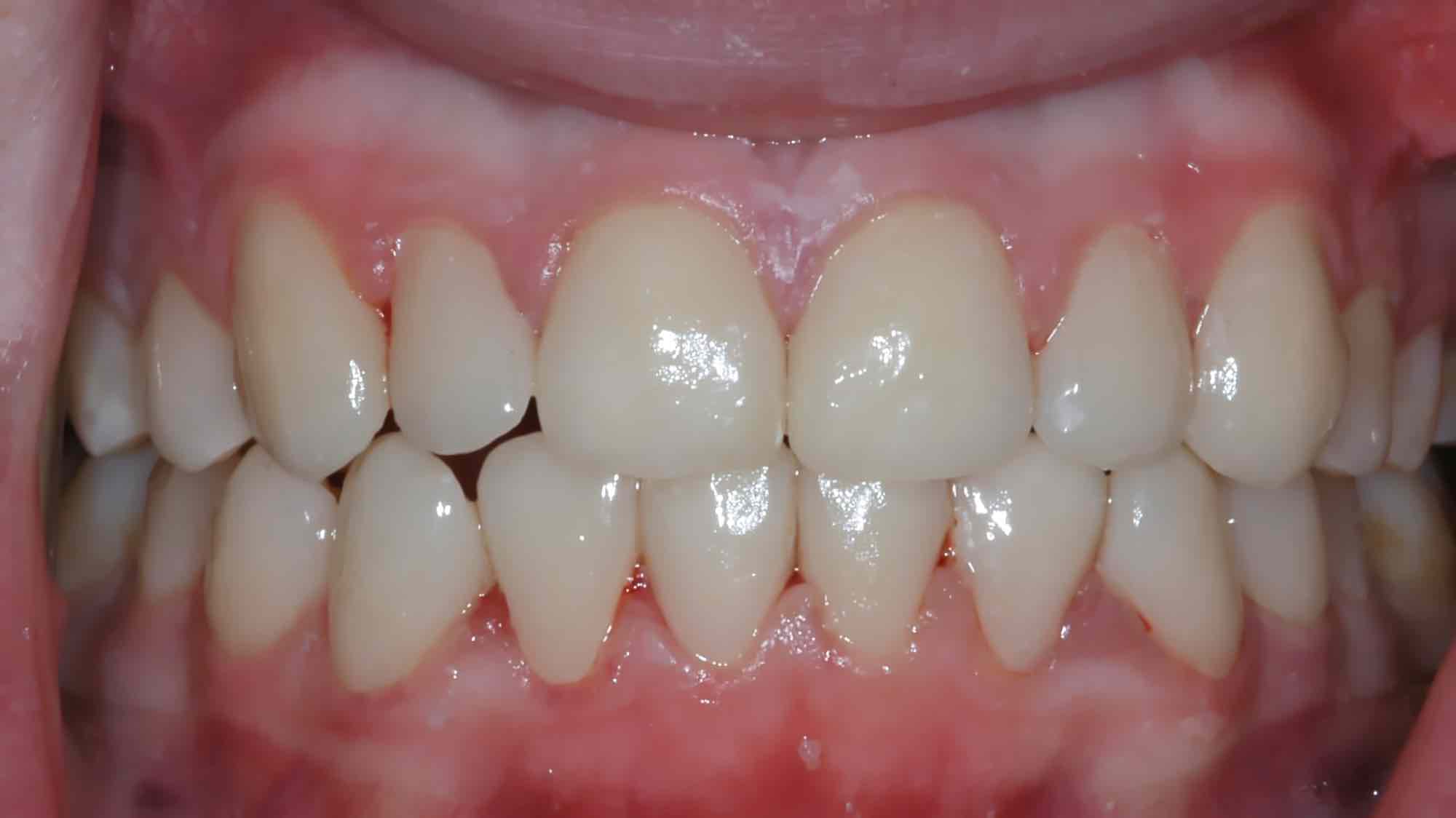 Versorgung mit Keramik-Veneers